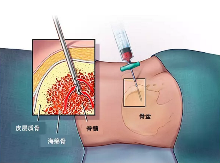 穿刺針沖壓廠家